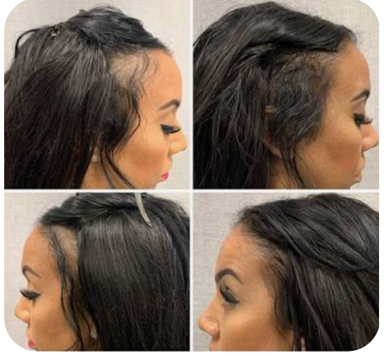 Full Scalp Micropigmentation