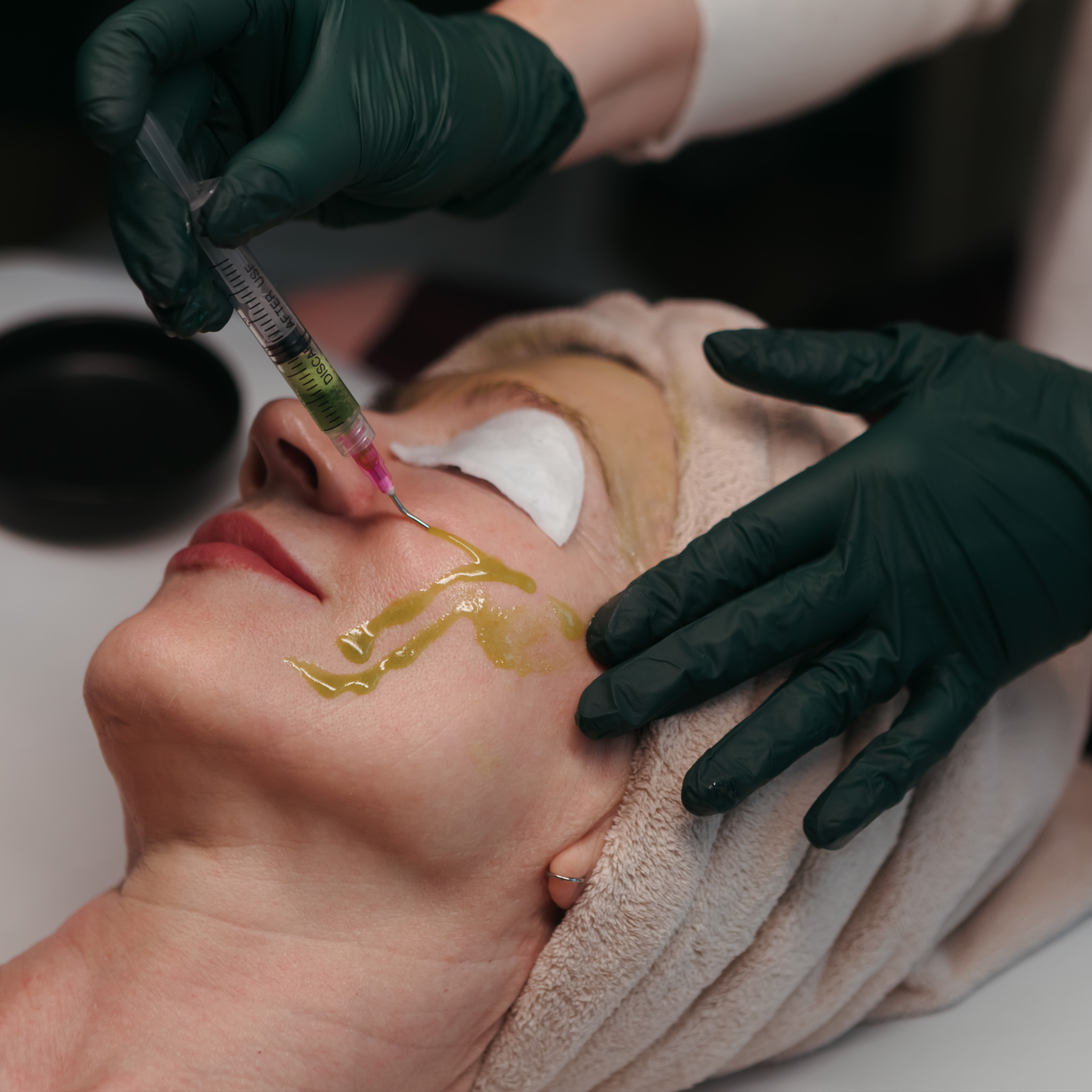 BioRePeel at Alchemy Aesthetics in University Place, WA