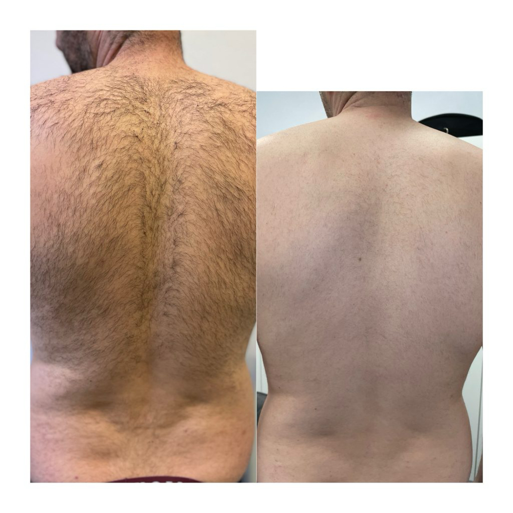 Full Back/Chest Wax