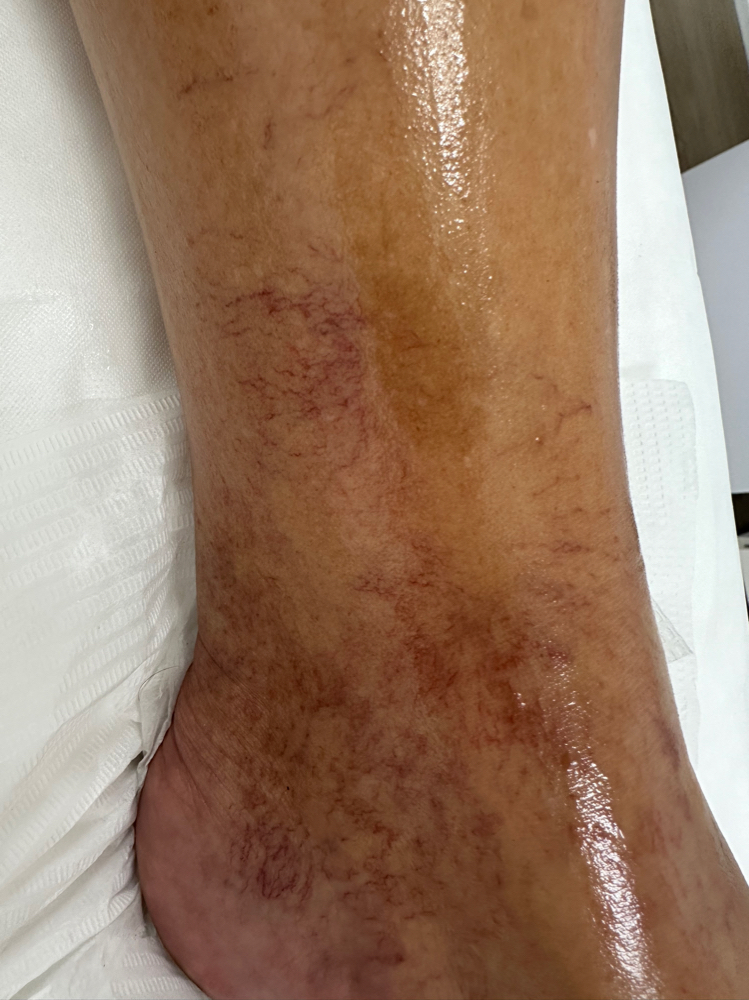 Vericose Vein Health