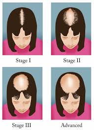 Alopecia Hair Consultation