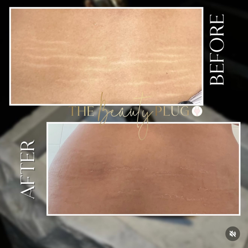 Paramedical Stretch Mark Revision at Body Contouring & More in Modesto, CA