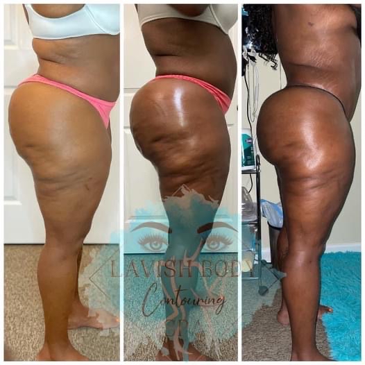 12 Butt Enhancement Sessions
