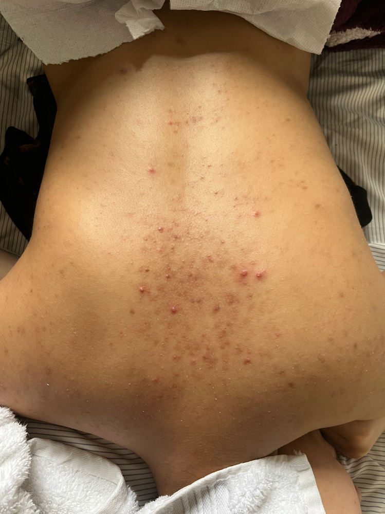 Acne Back Treatment