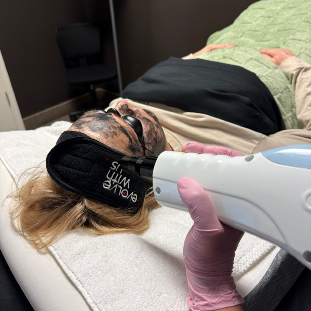 CARBON LASER FACIAL at Ageless Beauty in Janesville, WI