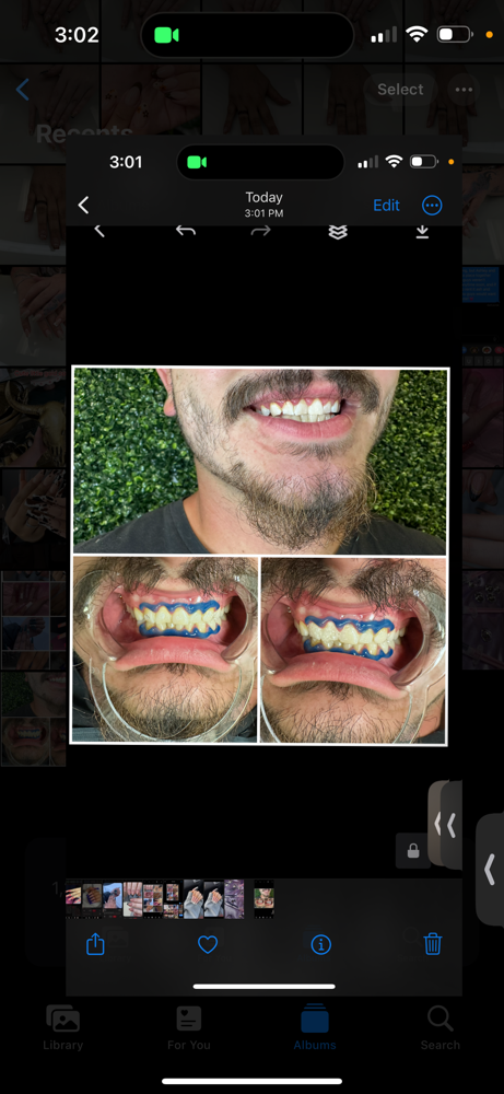 Teeth Whitening