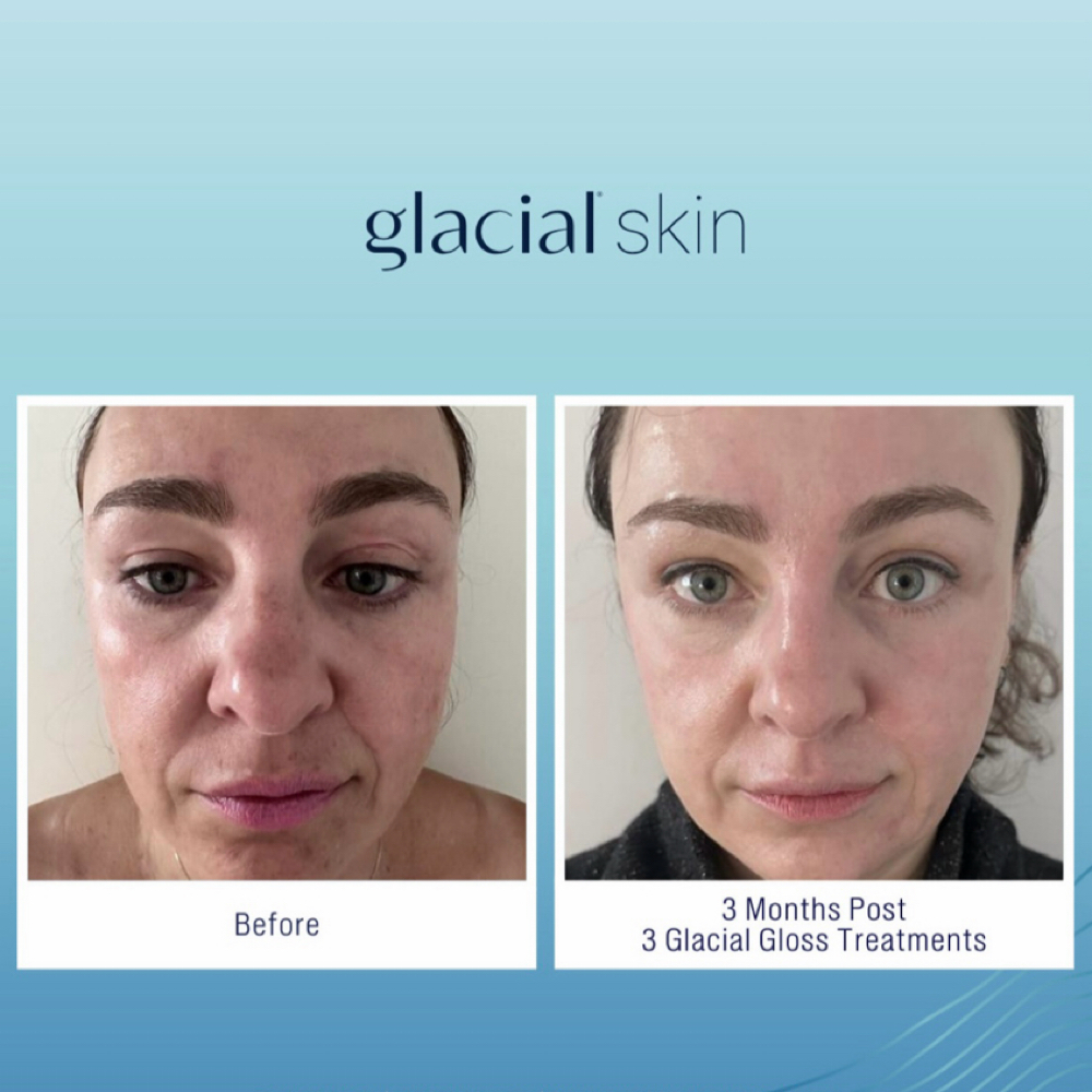 5 Glacial Gloss Treatment at SKIN CLINIC in Laguna Hills, CA