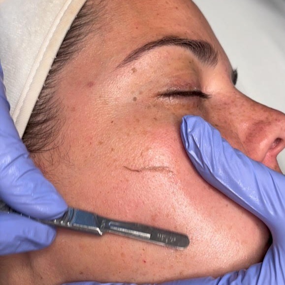 Dermaplane Facial at Melt n’ Glow Esthetics in Apex, NC