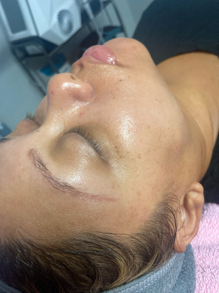 GLOW FACIAL (Hydrofacial)