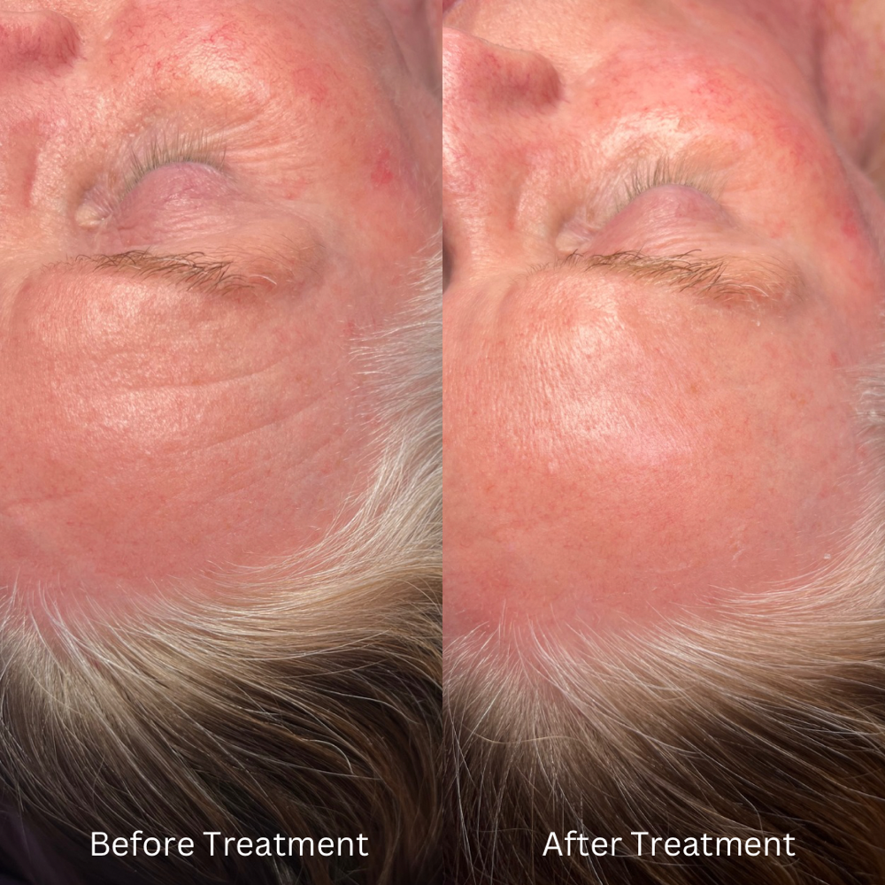 The Botox Treatment