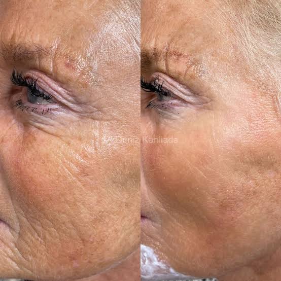 Crow’s feet around eyes at Natural Glow in Grand Praire, TX