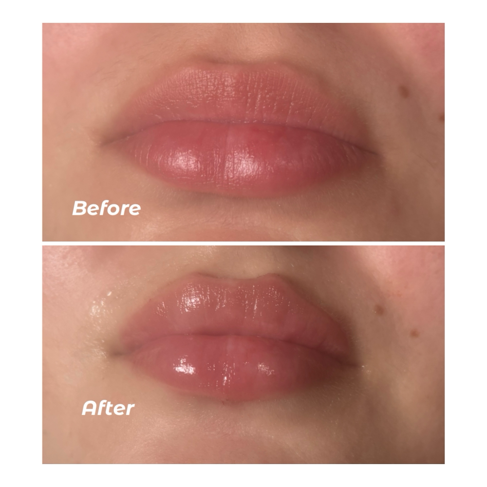 January Lip Filler Promo