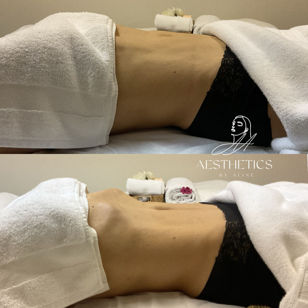 12 Sessions Of Lymphatic Drainage