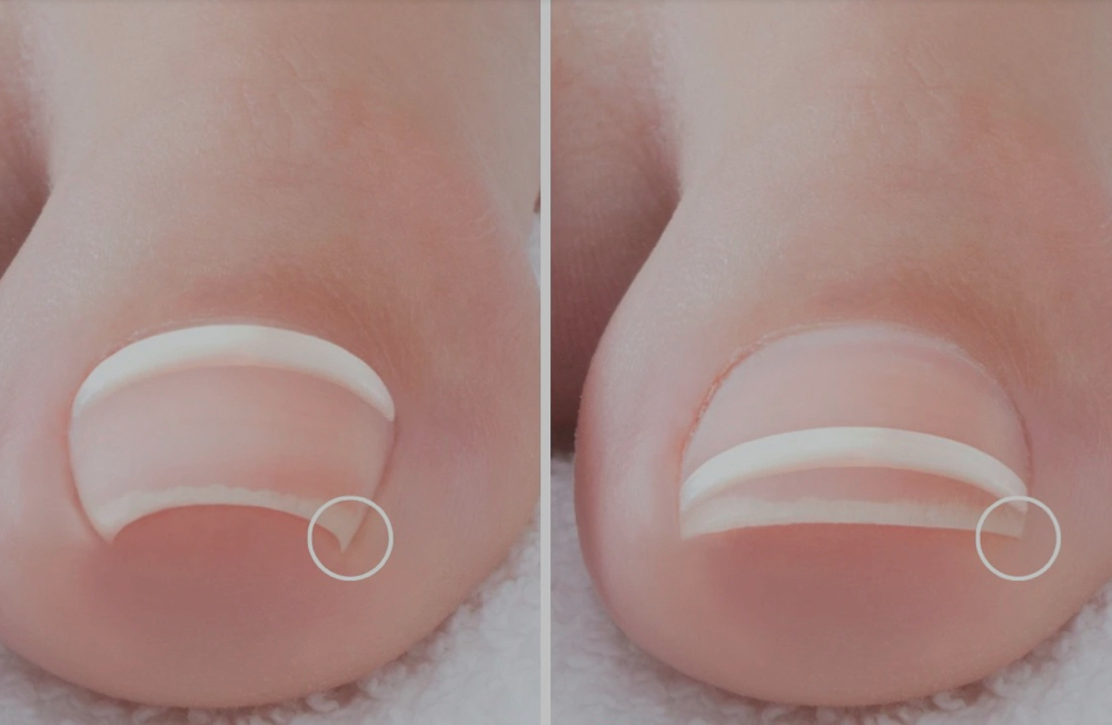 Onyfix | NAIL CORRECTION