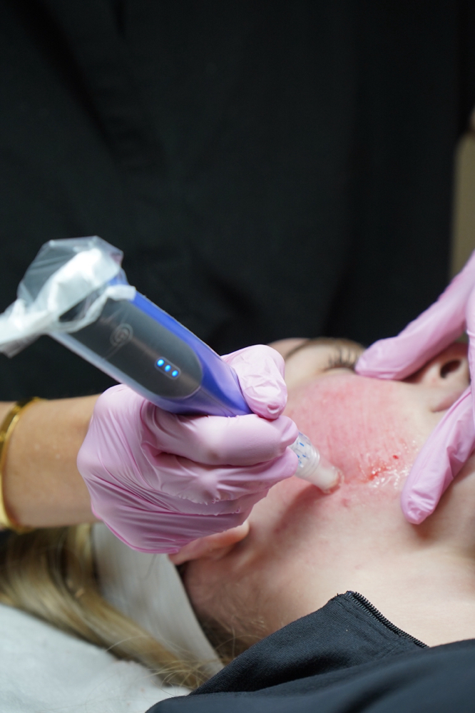 SkinPen at Skin Aesthetics Studio in East Bernard, TX