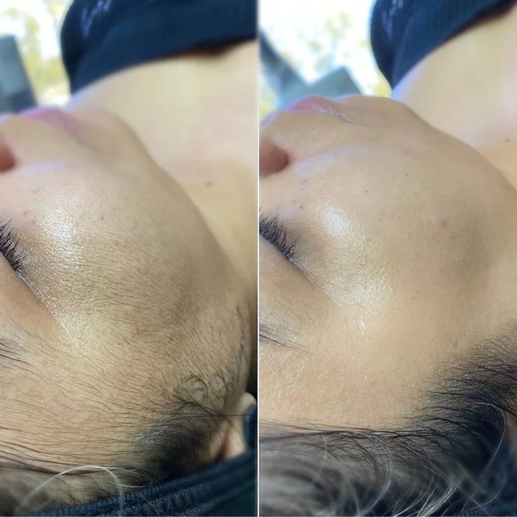 Dermaplane Facial at Piper K Skin Care in Peoria, IL