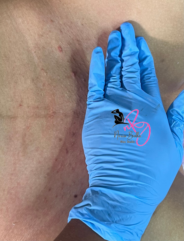 Brazilian w/ Extractions