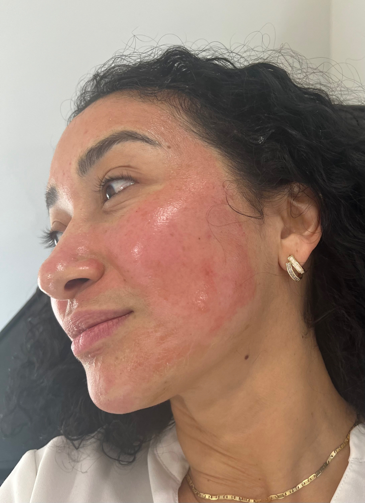 Microneedling Full Face