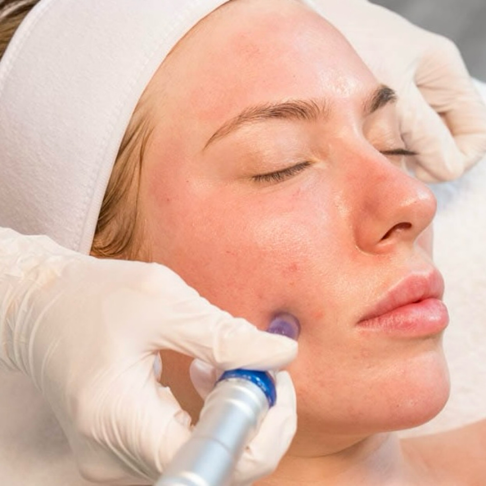 Micro Needling at Skin By Von in Kennett Square, PA
