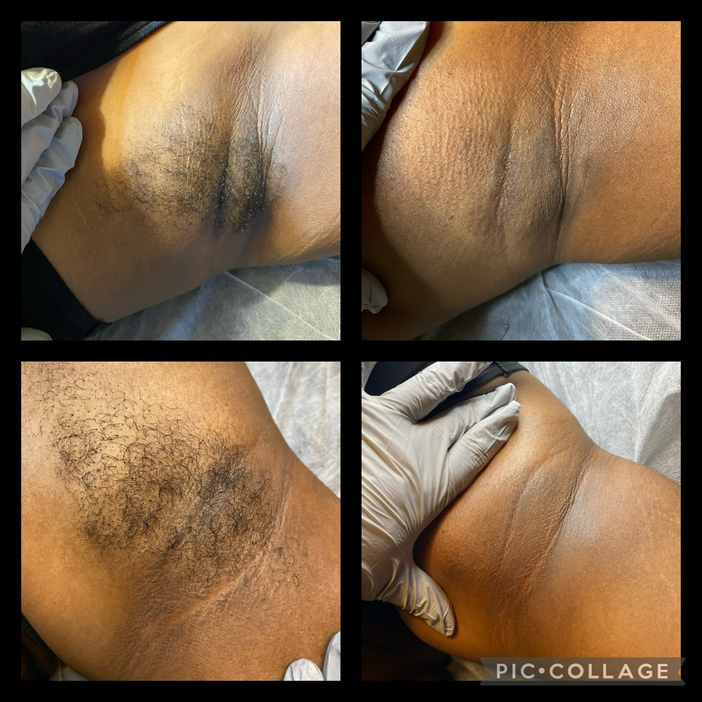 Underarms