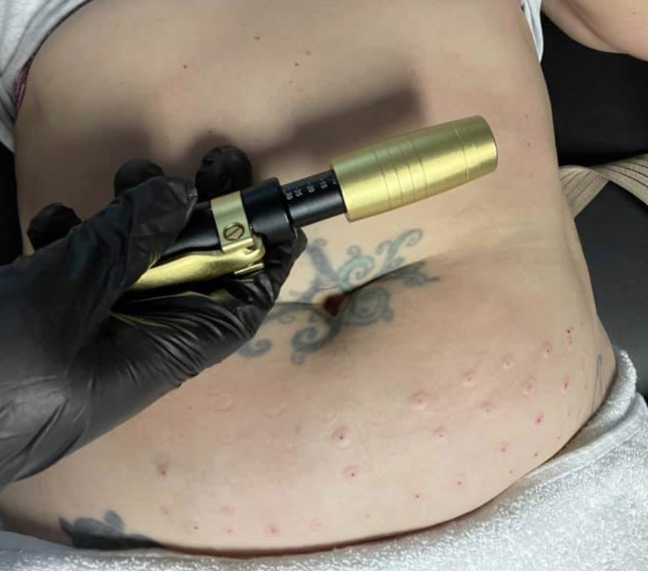 Mesotherapy Fat Dissolving 💉