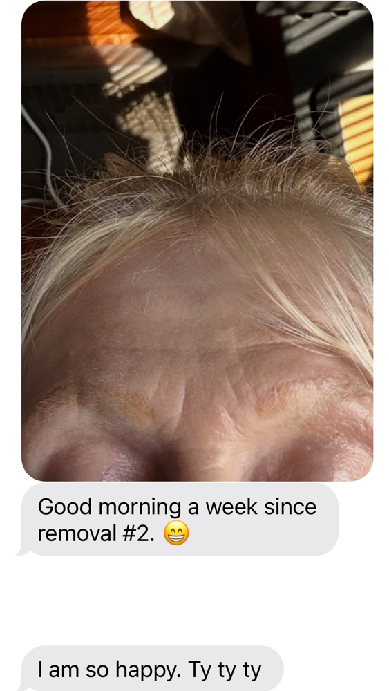 Brow or Tattoo Removal