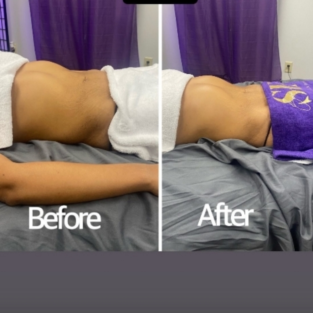 Brazilian Lynphatic Drainage Massag