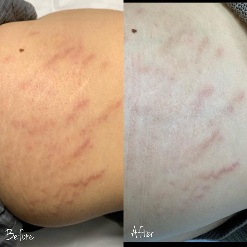 Stretch Mark/Scar Camouflage