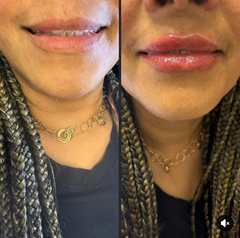 Hyaluronic Needless Lip Filler