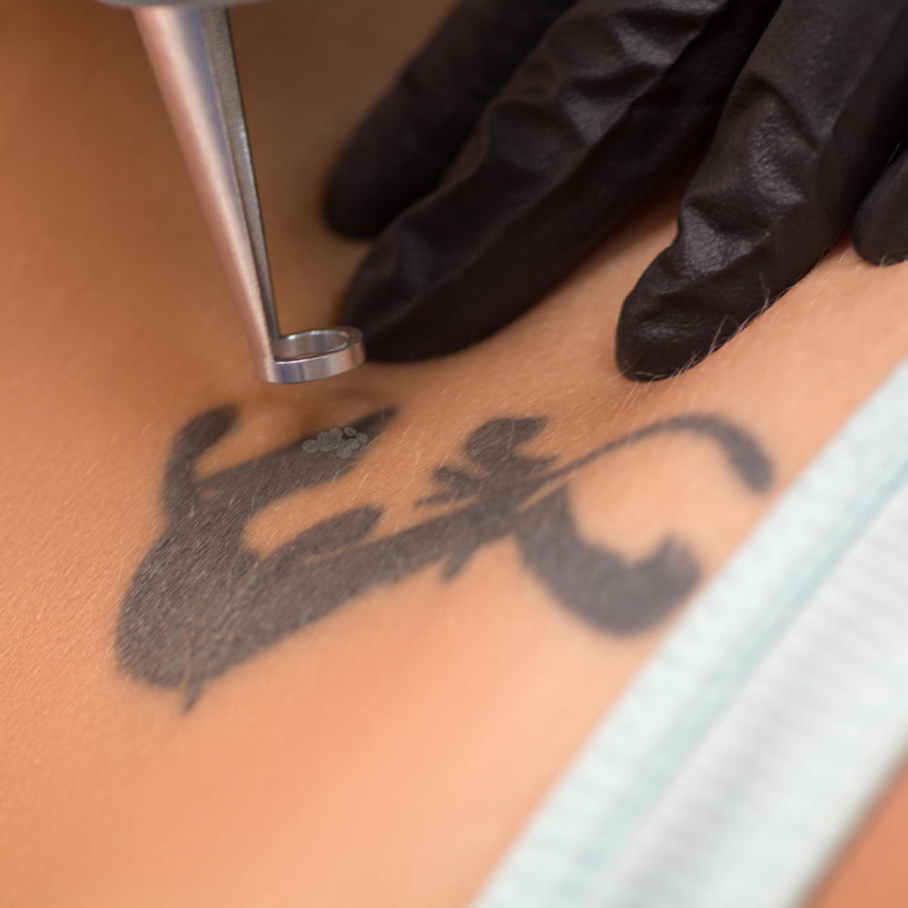 Tattoo Removal Consultation