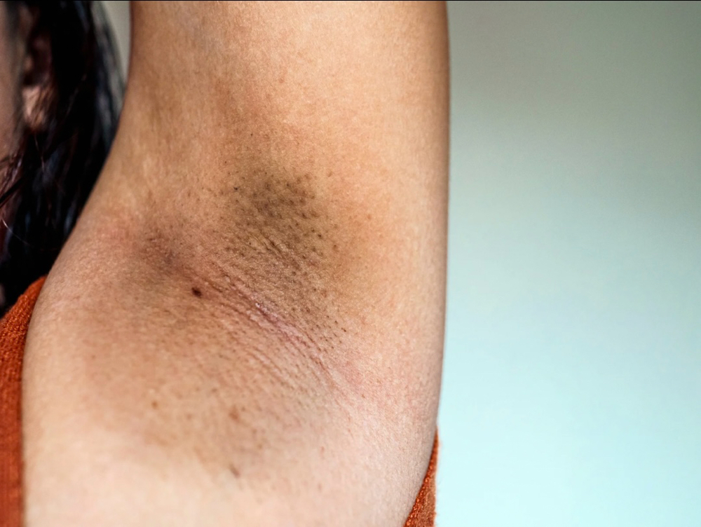Hyperpigmentation Treatment