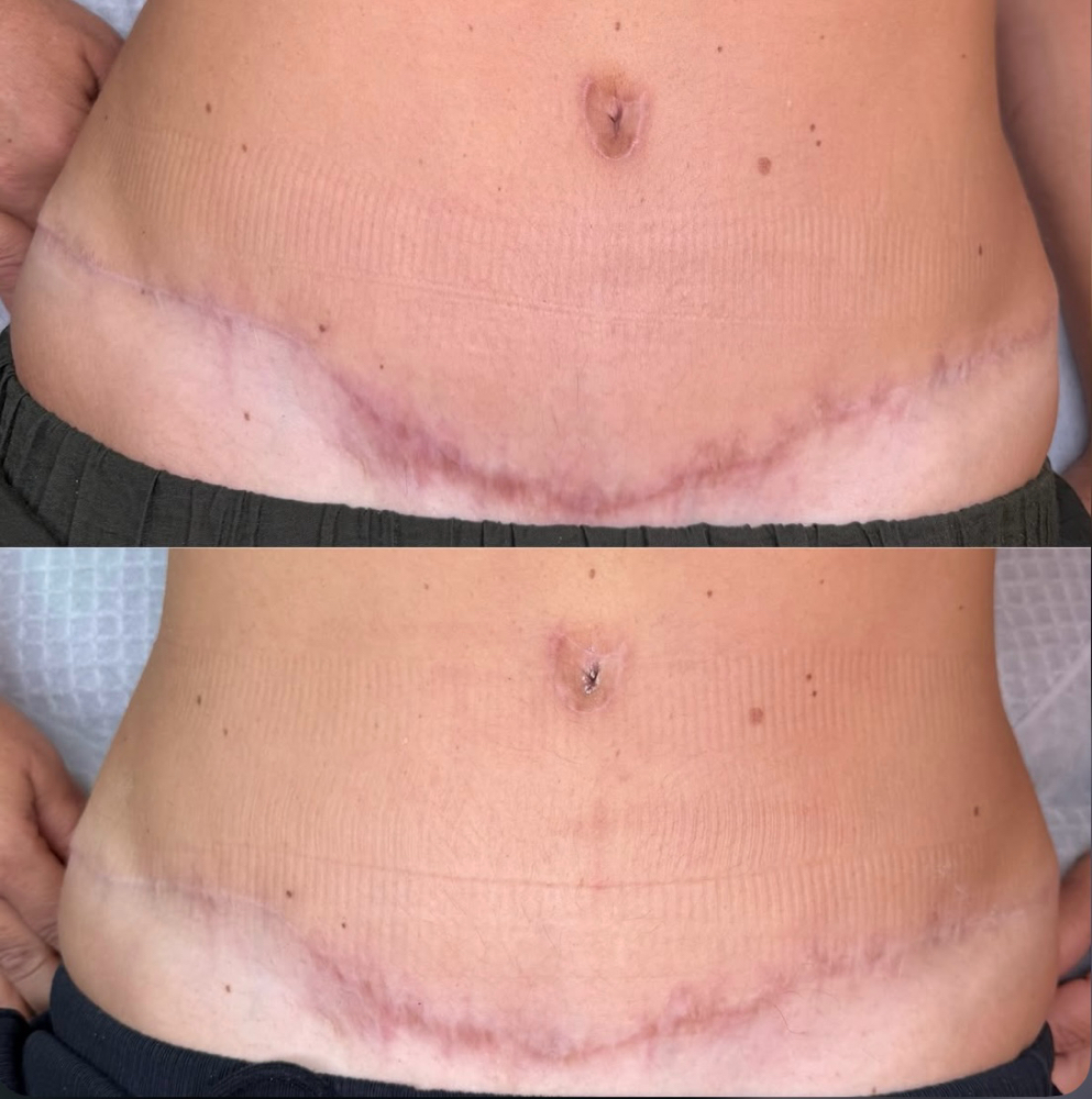 Inkless Scar Revision (medium Area