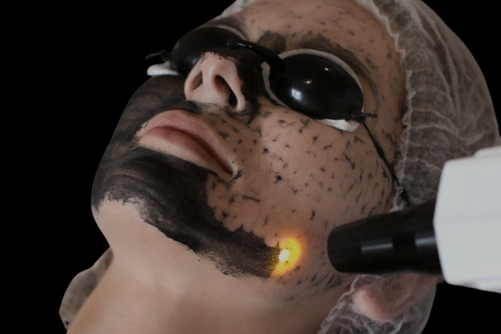 Laser Carbon Peel/Hollywood Facial