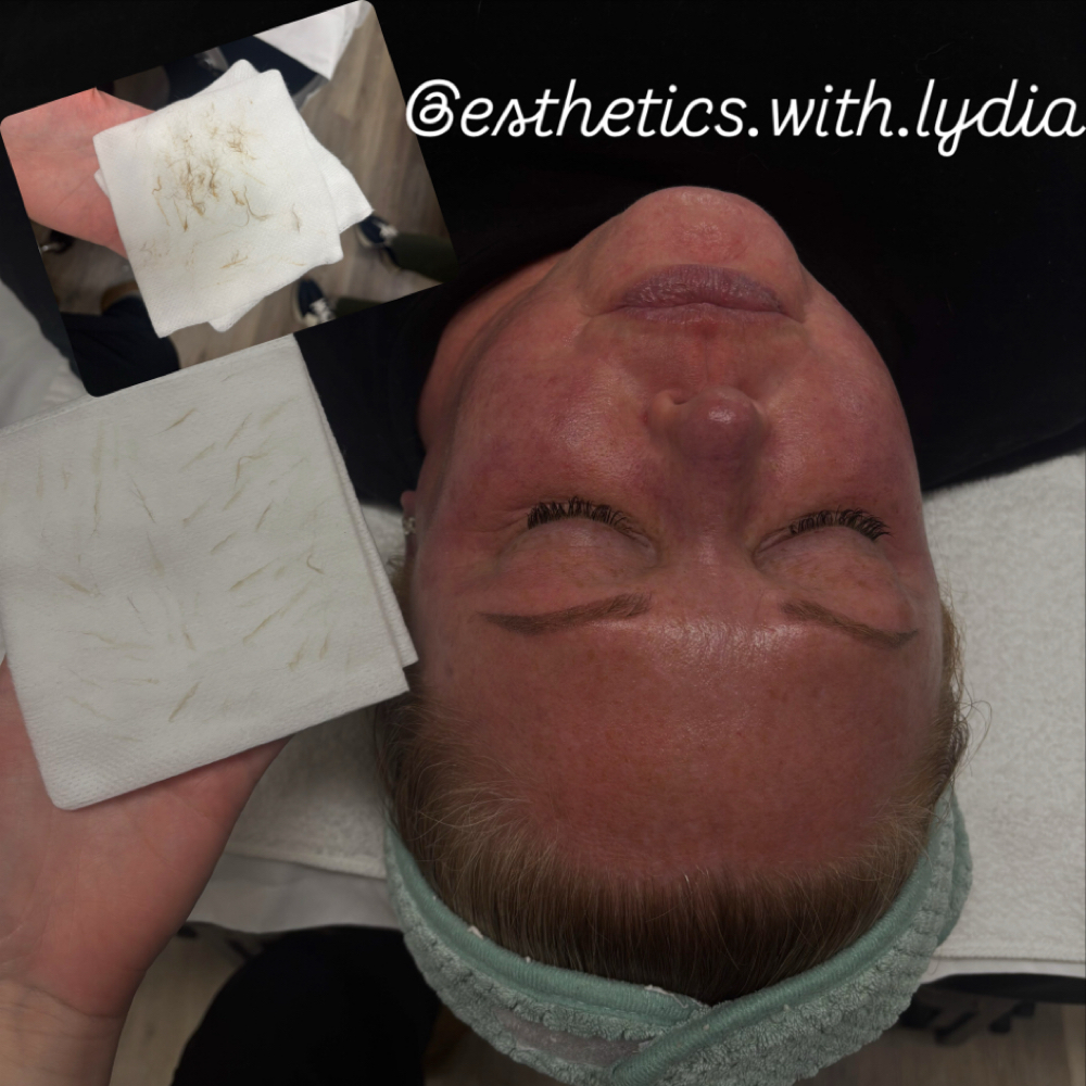 DERMAPLANING FACIAL