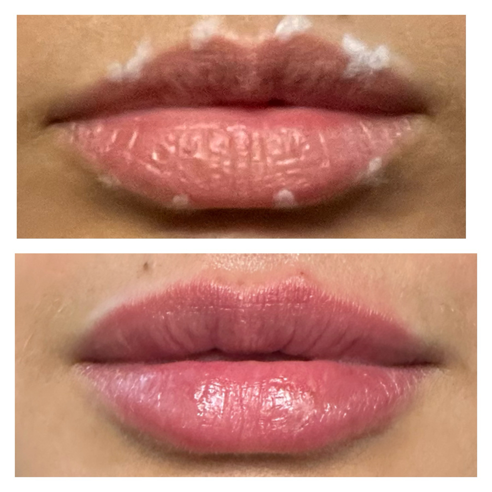 Half Syringe Lip Filler