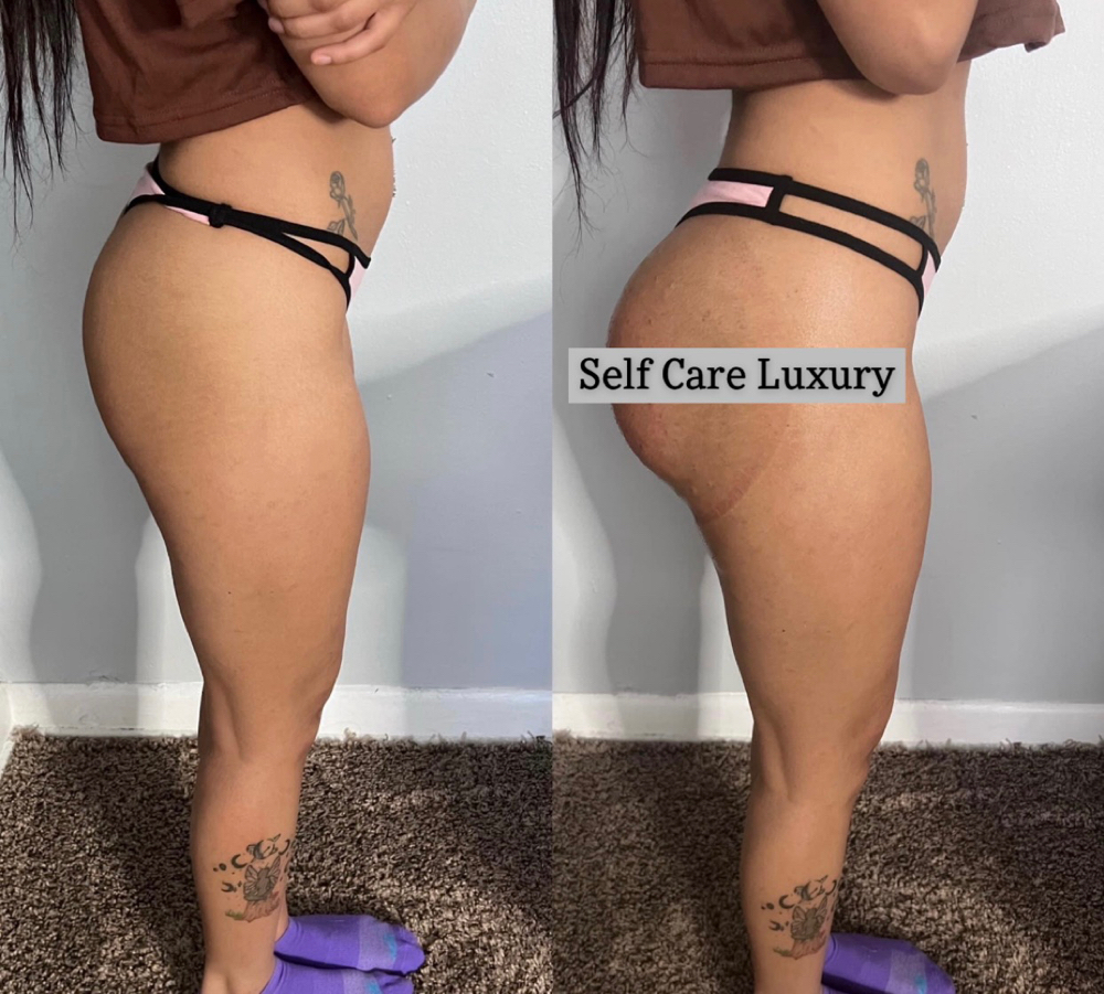 Non Surgical Brazillian Butt Lift