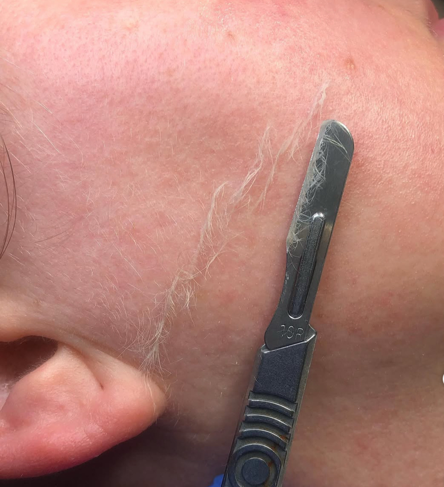 Dermaplaning Treatment