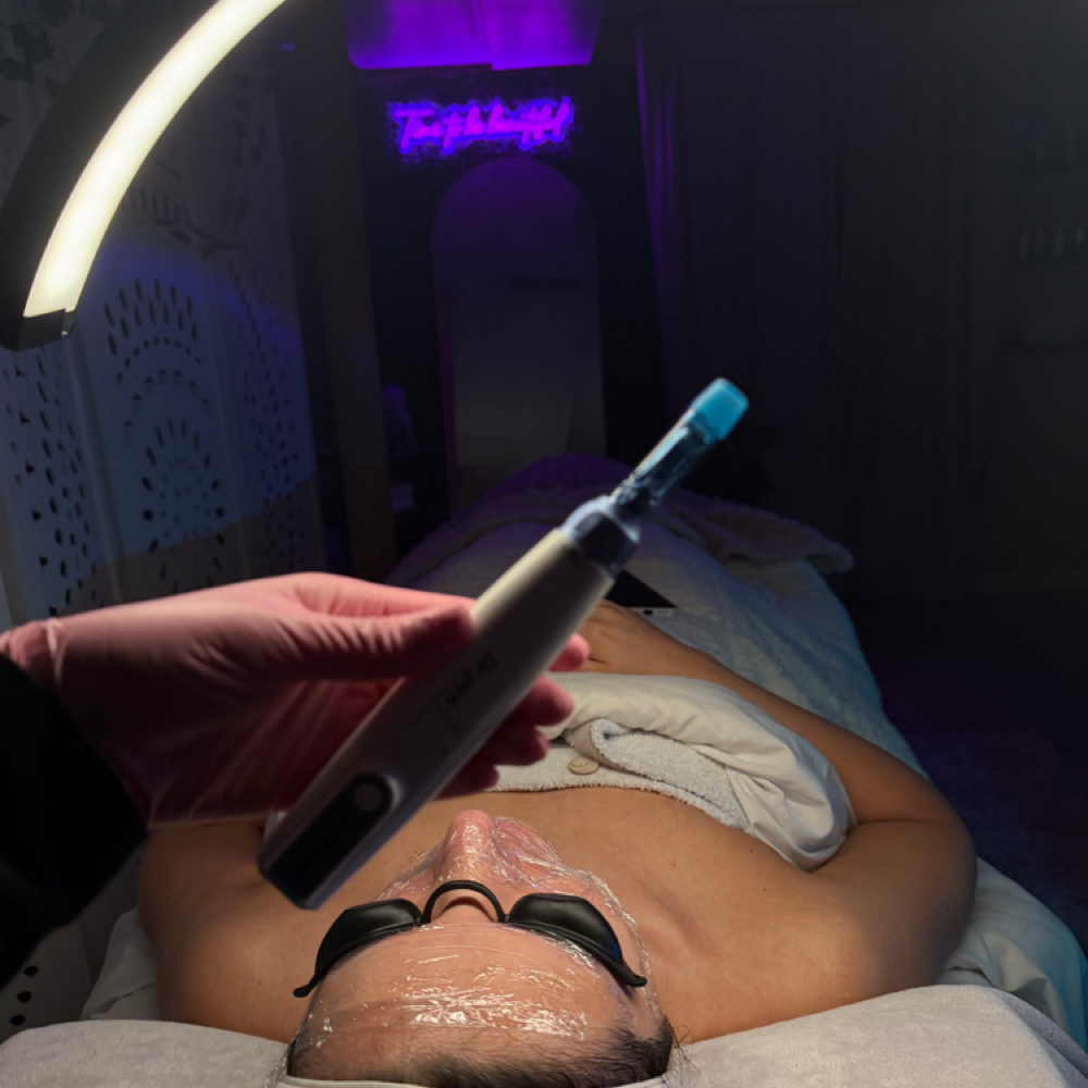Microneedling at skin by gianna v in yorktown, NY
