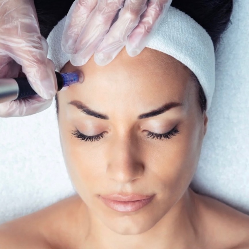 Microneedling (PLEASE READ BELOW) at Soft Life Aesthetics in Des Peres, MO