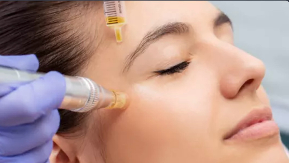 360 PRF Microneedling