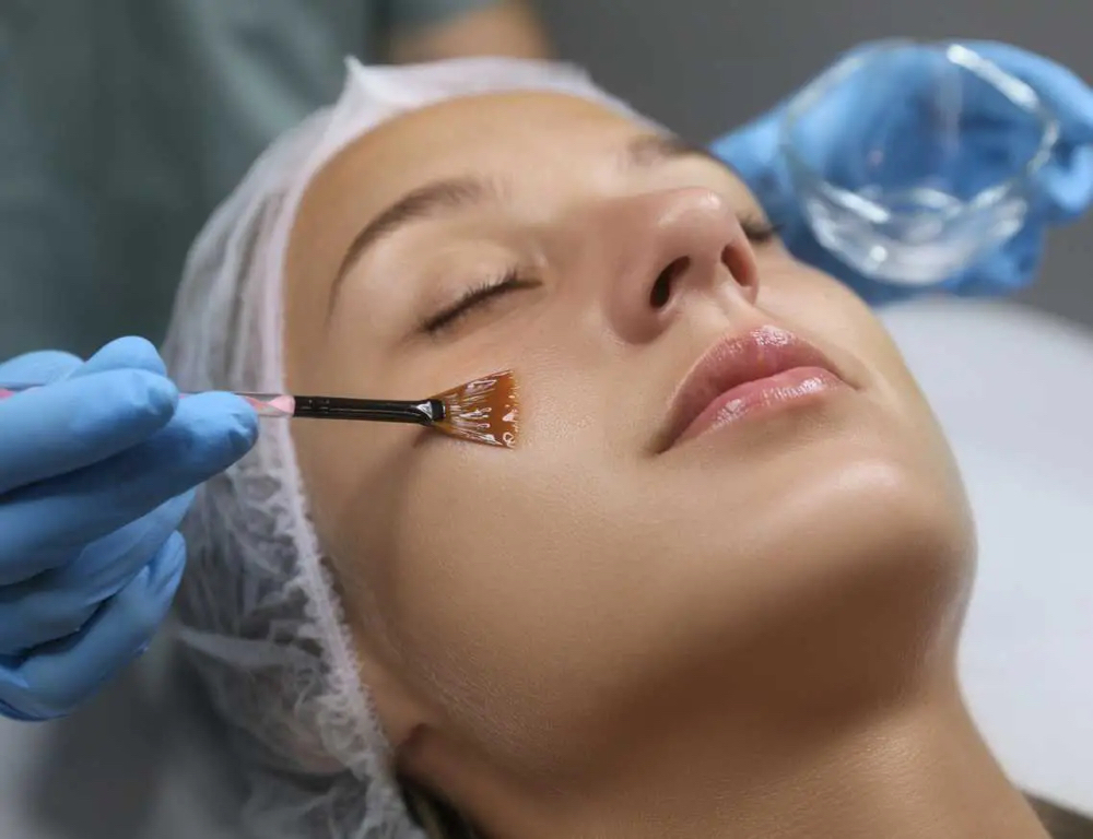 Chemical Peel Facial