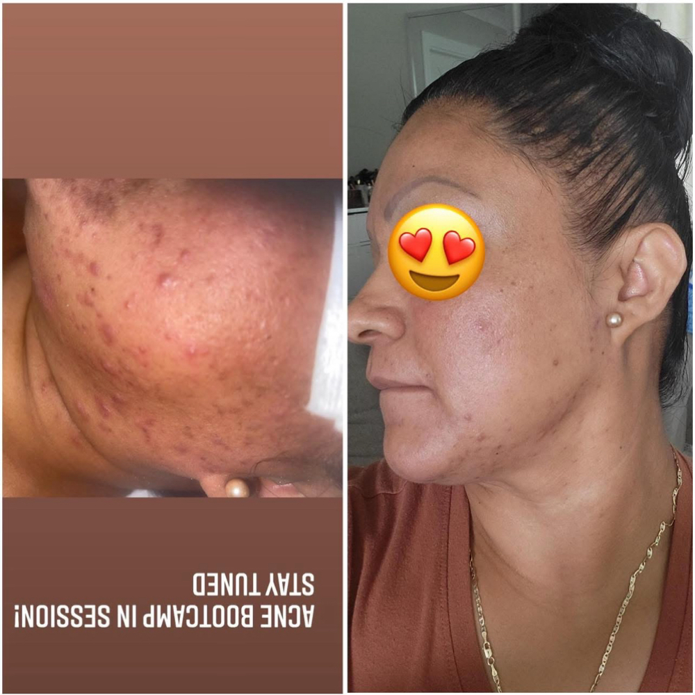 Jessner Peel at Advanced Skincare & Laser By Jess in Naples, FL