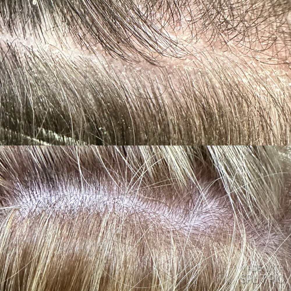 Scalp Treatment