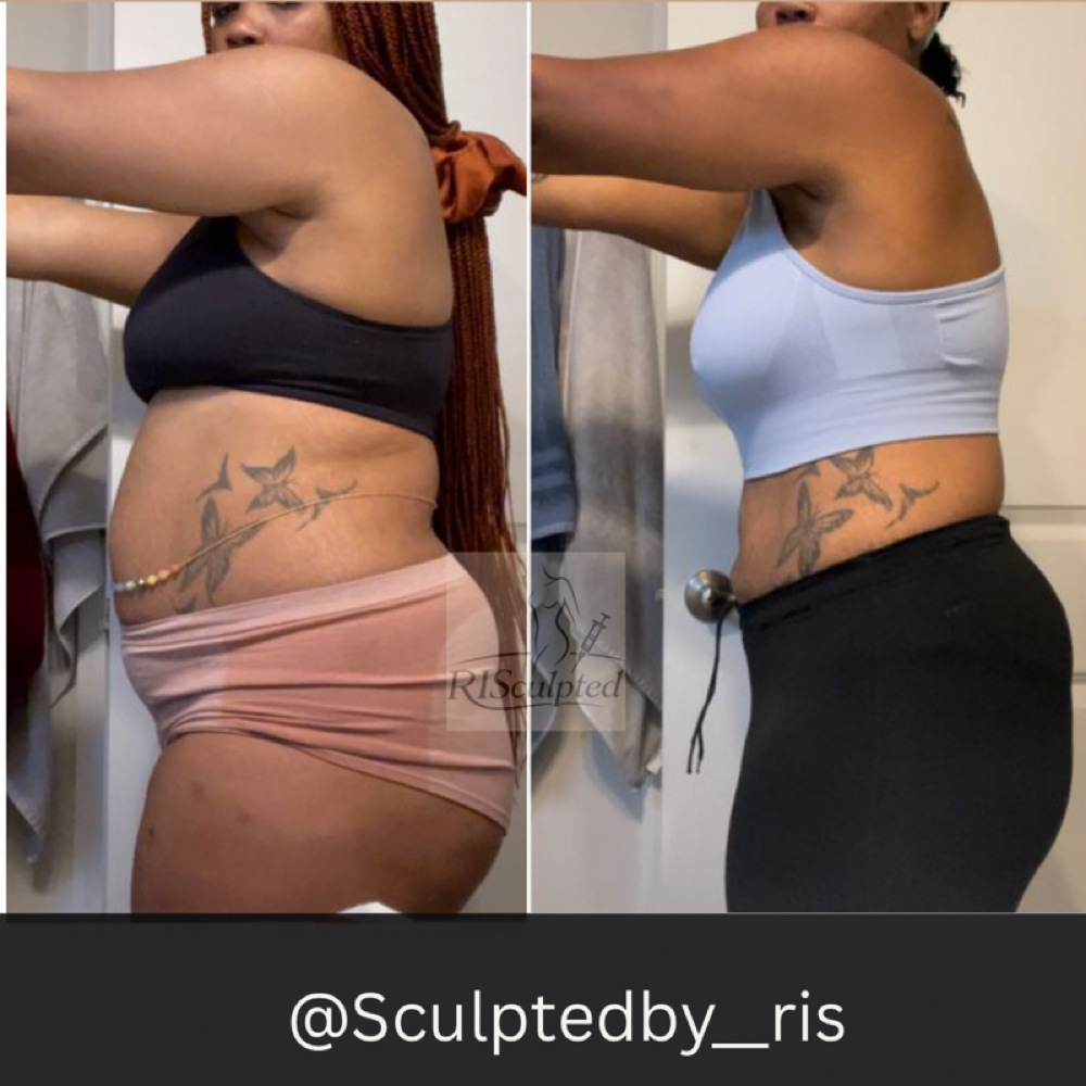 Lipo “Advanced” Package at RISculpted Aesthetics in Stockbridge, GA
