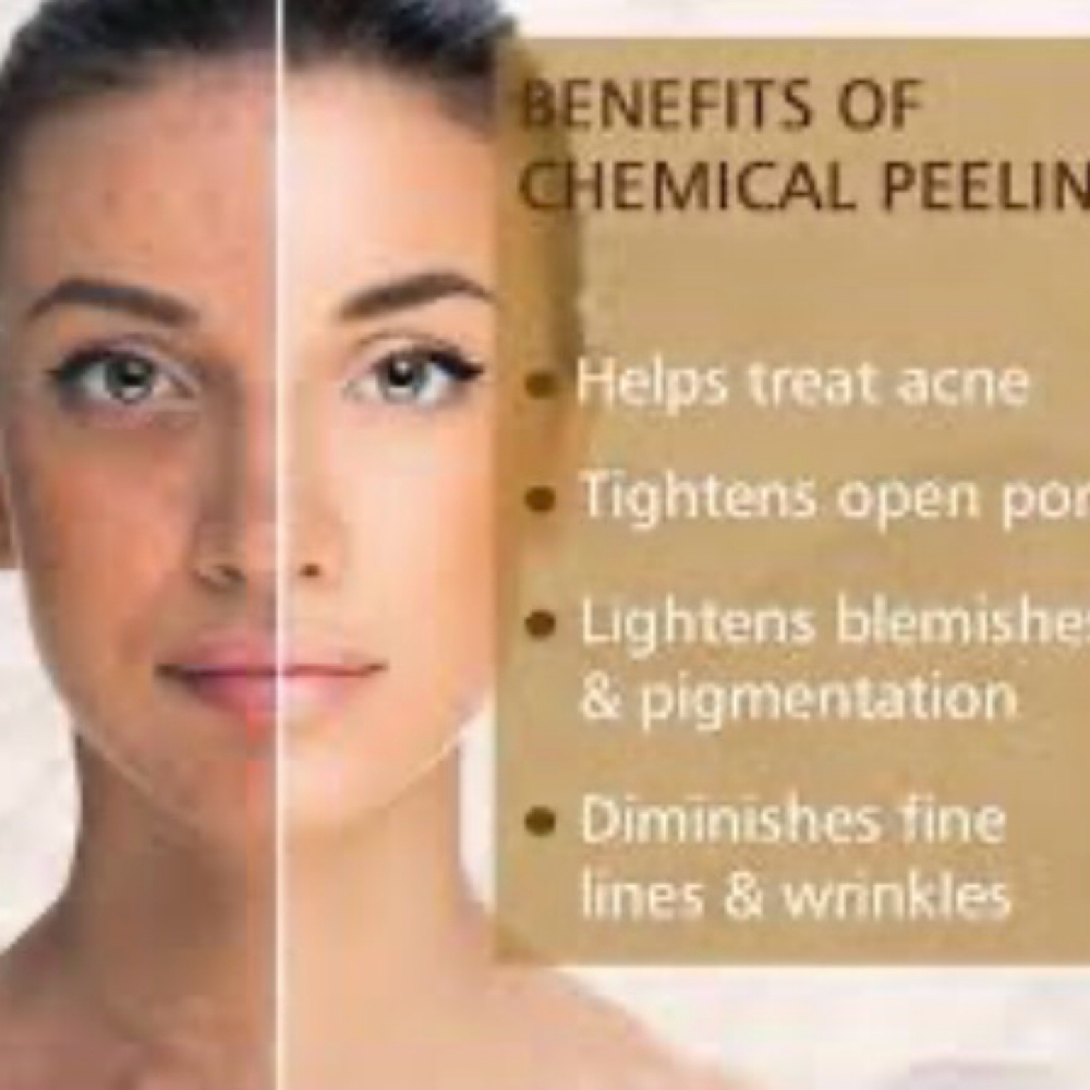 Customized Chemical Peel at Antidote Mobile Studio