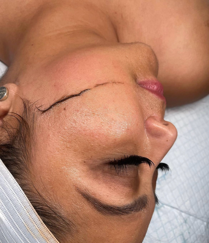 Dermaplanning Facial