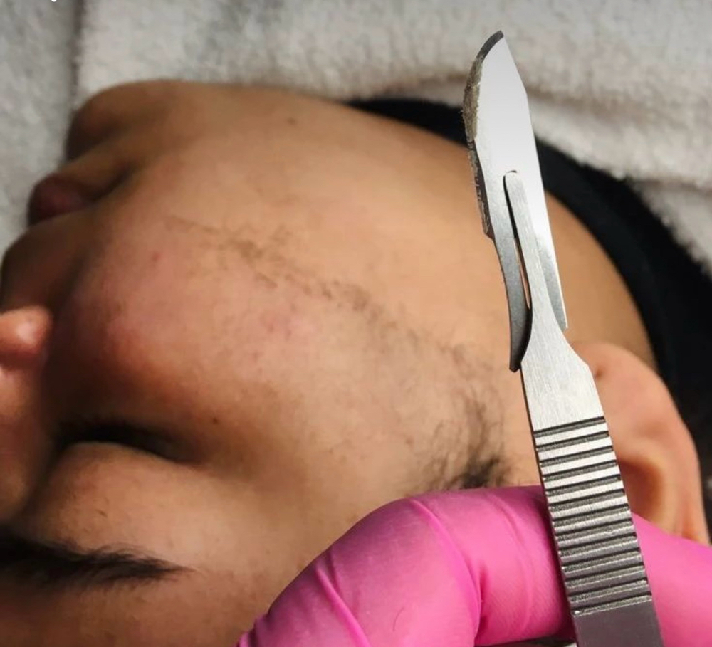 Dermaplaning Facial
