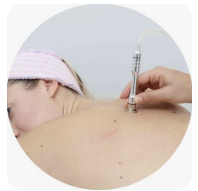 Microdermabrasion Back Facial