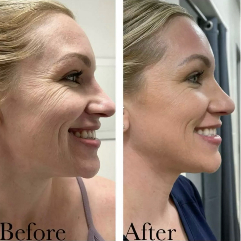 ProCell Microchanneling Treatment at Polished Pearl in Columbus, OH
