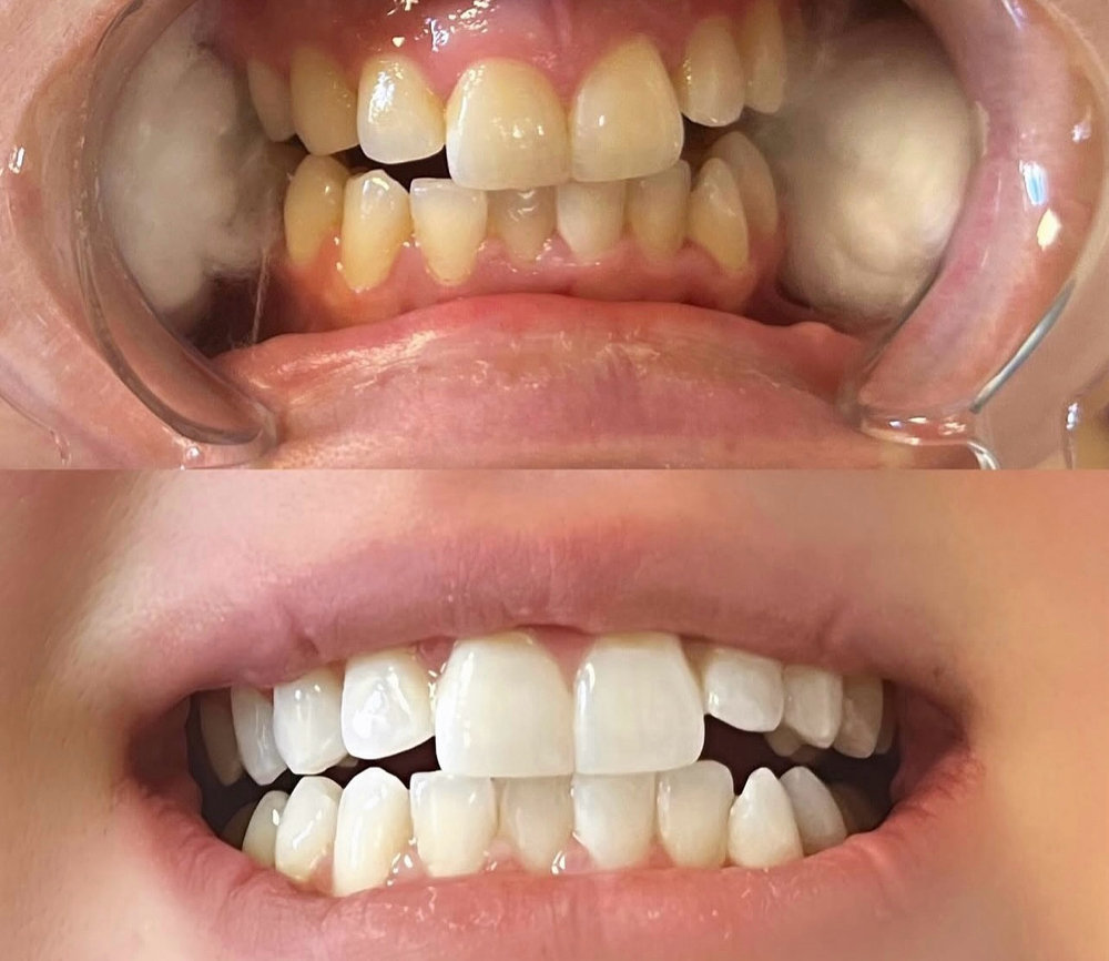 Teeth Whitening (40 minutes)